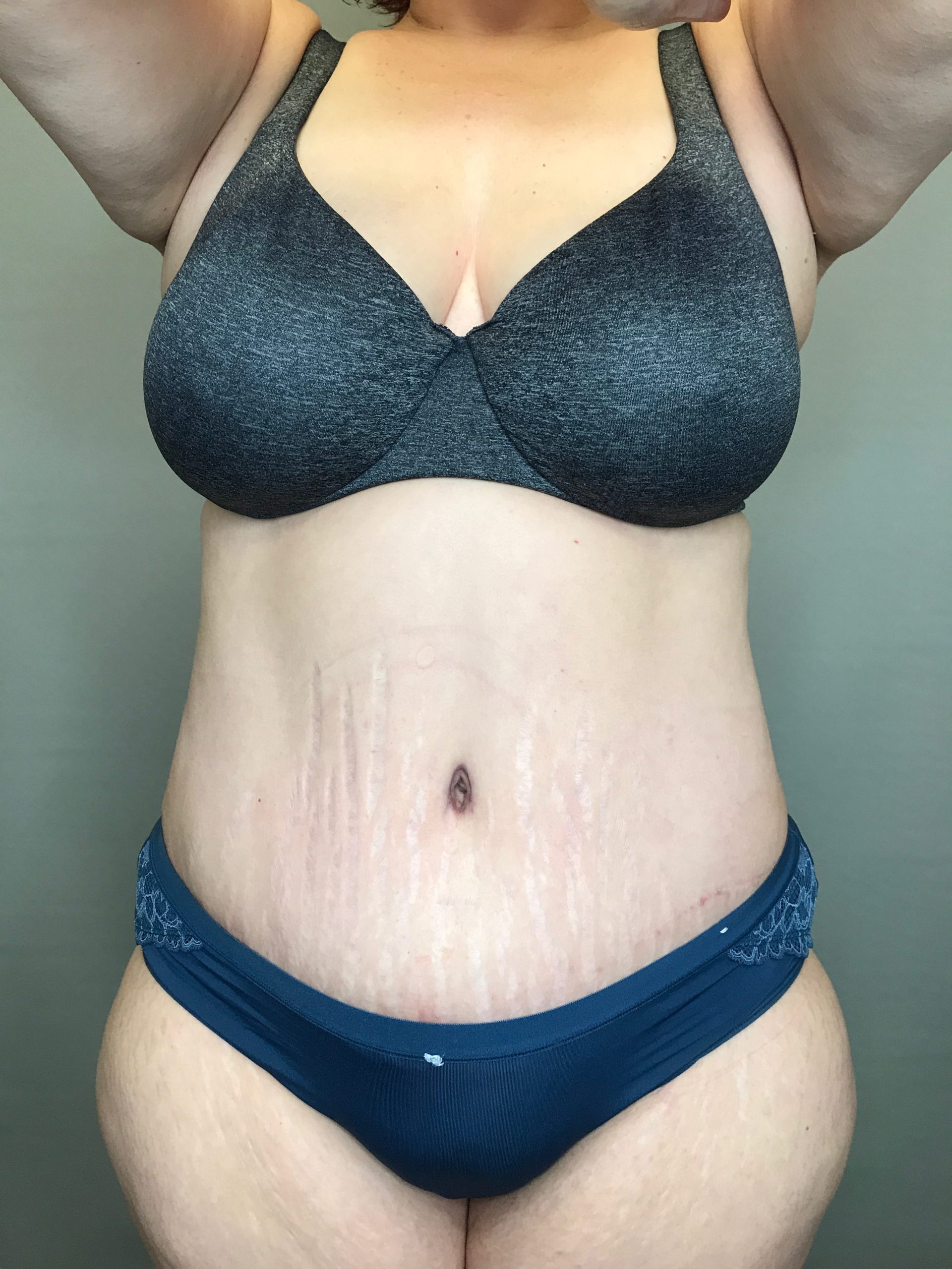 Tummy Tuck Before After Photos Lift Plastic Surgery