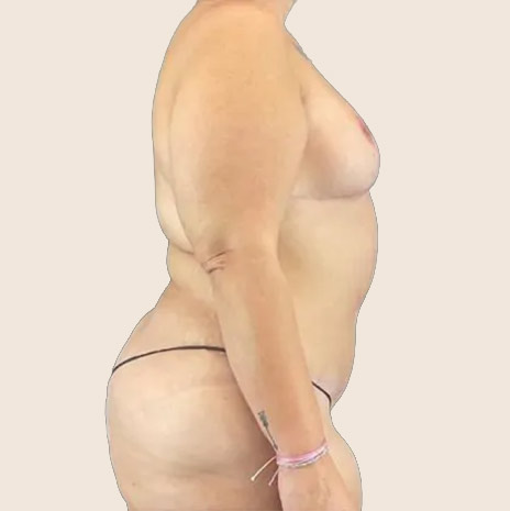 Second patient after treatment — side view of the torso