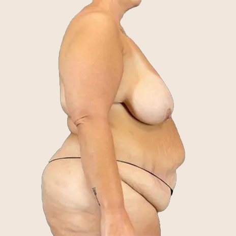 Second patient before treatment — side view of the torso