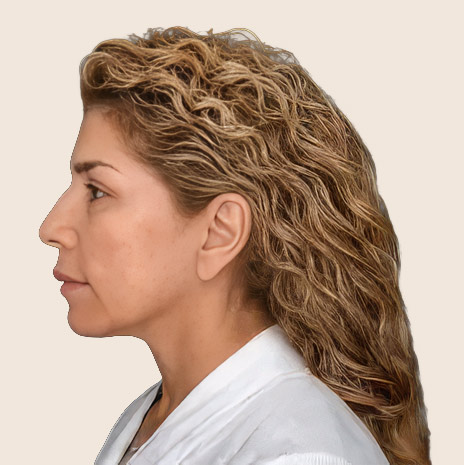Patient after treatment — side profile of the face and neck