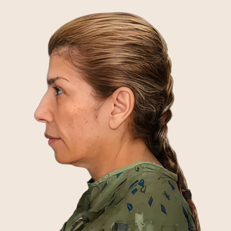 Patient before treatment — side profile of the face and neck