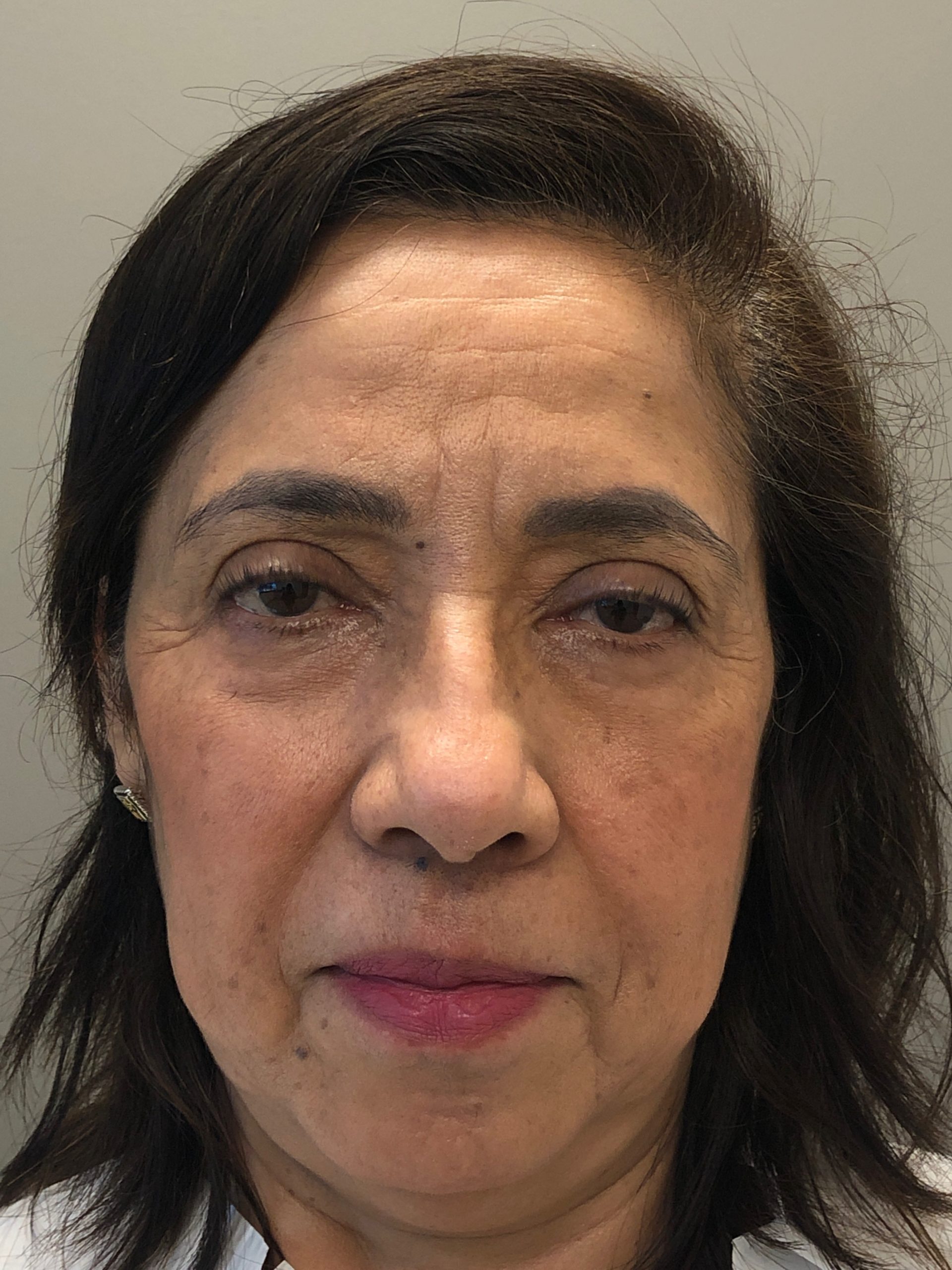 Eyelid Surgery (Blepharoplasty) Before &#038; After Photos
