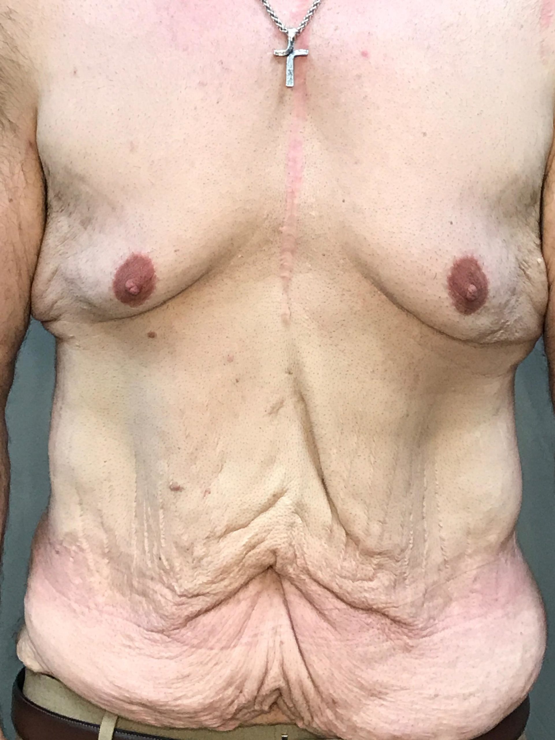Male Tummy Tuck Before &#038; After Photos