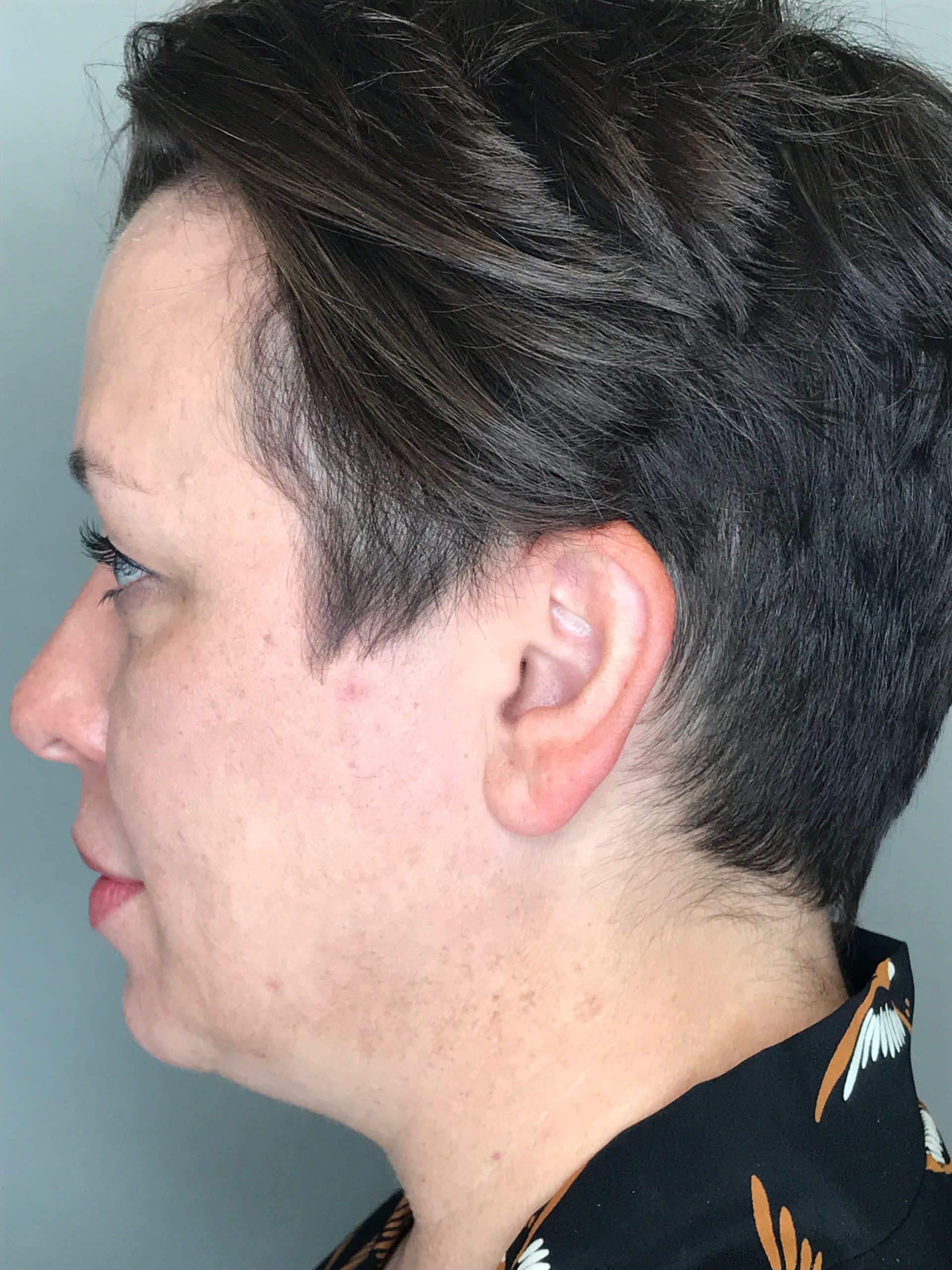 Ear Surgery Before &#038; After Photos