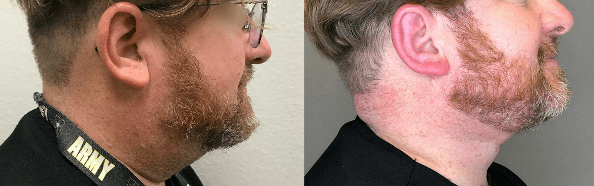Neck Lift Before &#038; After Photos