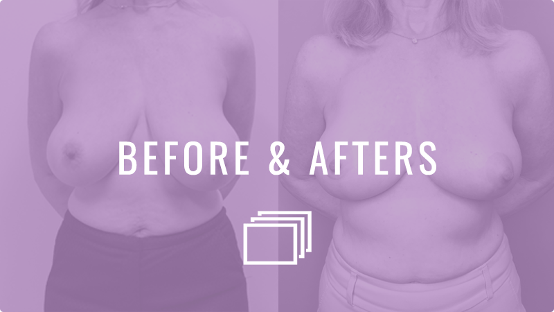 Breast Lift with Augmentation Houston