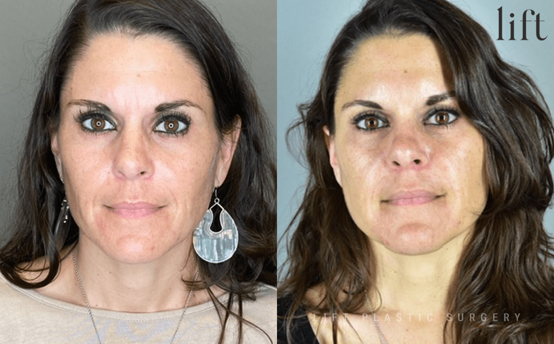 Botox Before &#038; After Photos