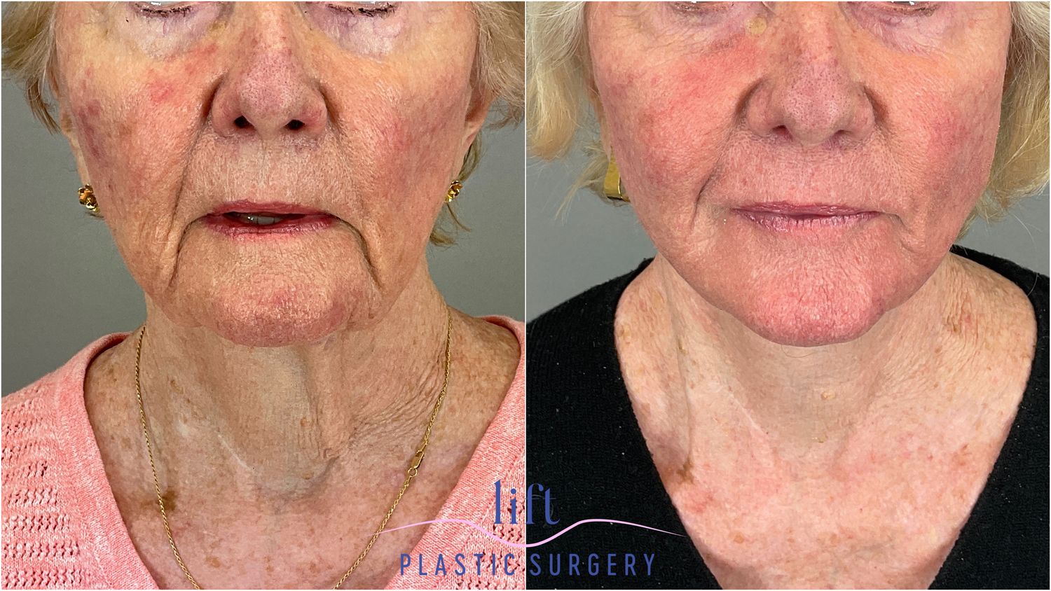 Facelift Before &#038; After Photos