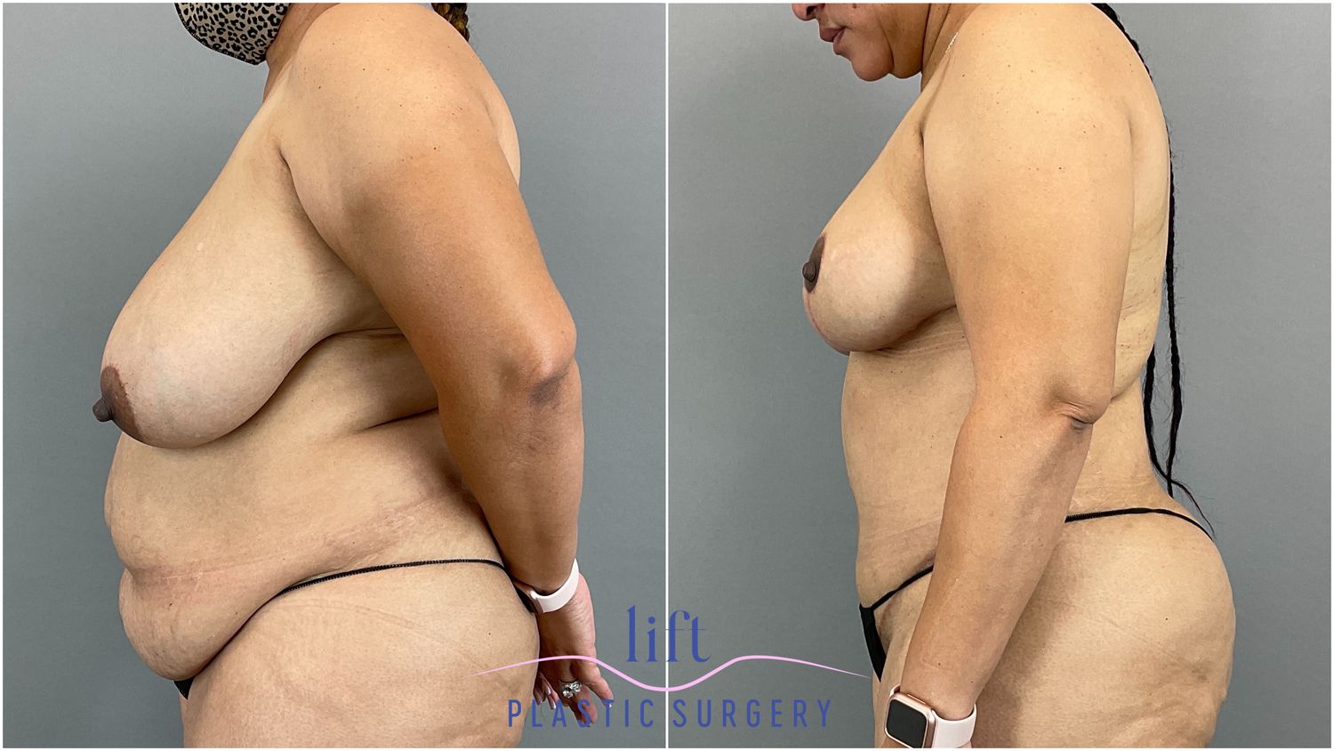 Breast Reduction Before &#038; After Photos