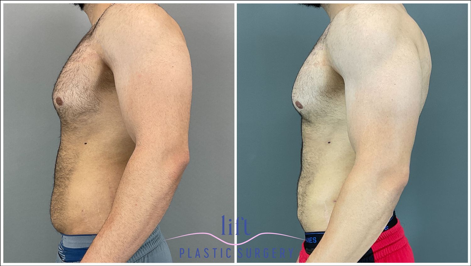 BodyTite Before &#038; After Photos