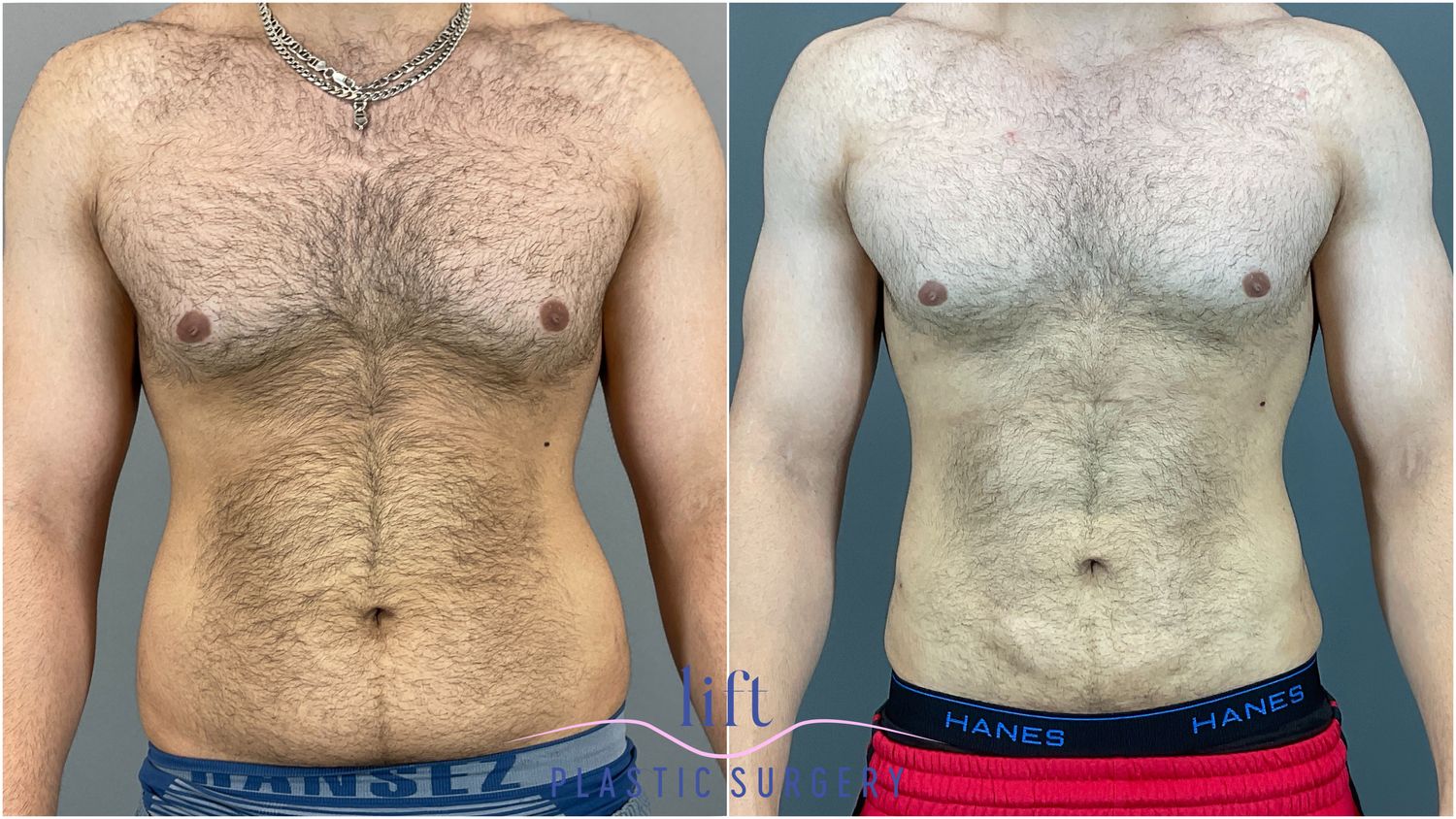 BodyTite Before &#038; After Photos