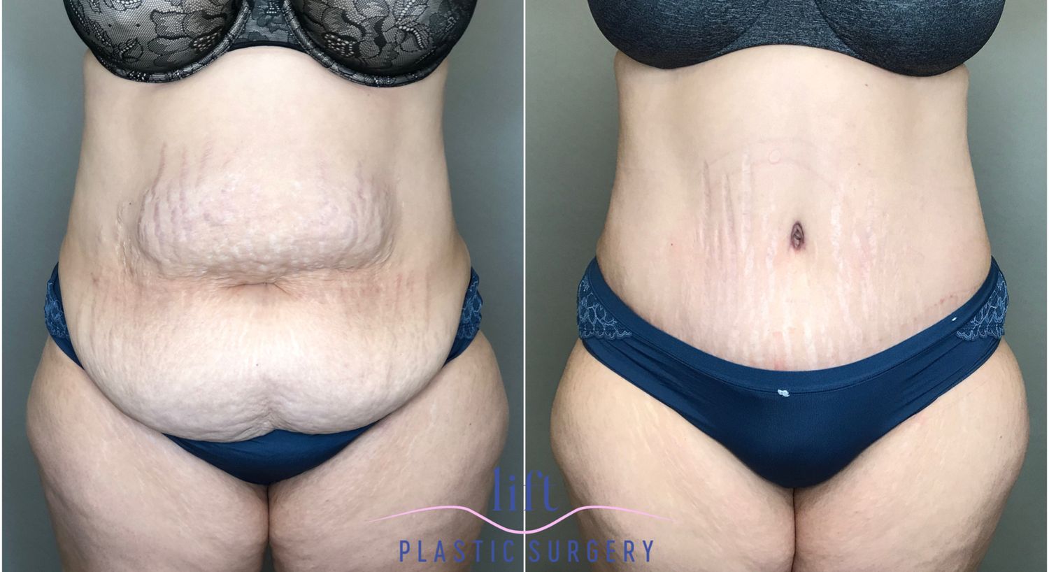 Panniculectomy Before &#038; After Photos