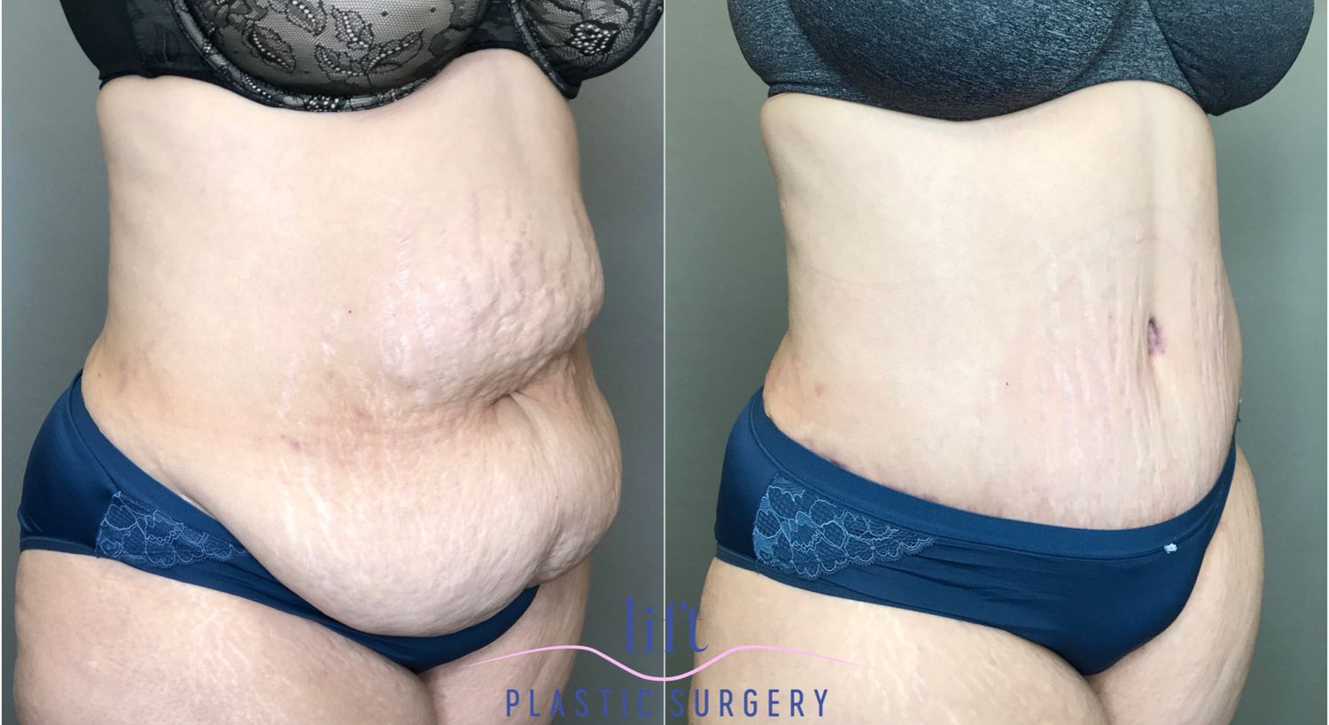 Panniculectomy Before &#038; After Photos