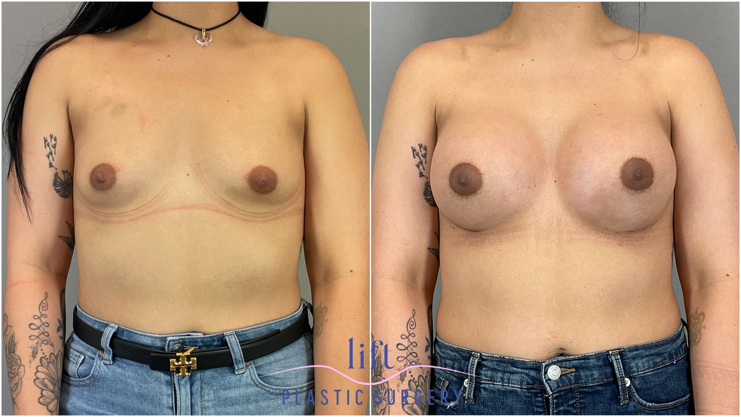 Breast Augmentation Before &#038; After Photos