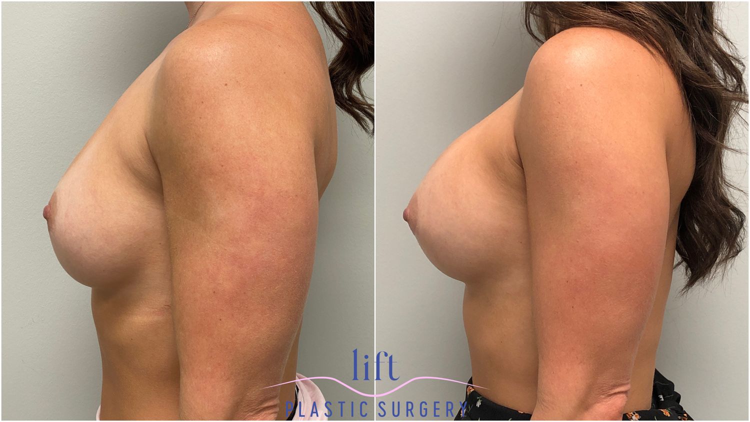 Breast Implant Exchange Before &#038; After Photos