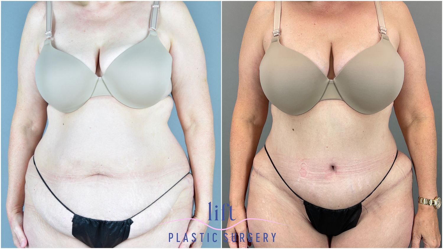 Tummy Tuck Before &#038; After Photos