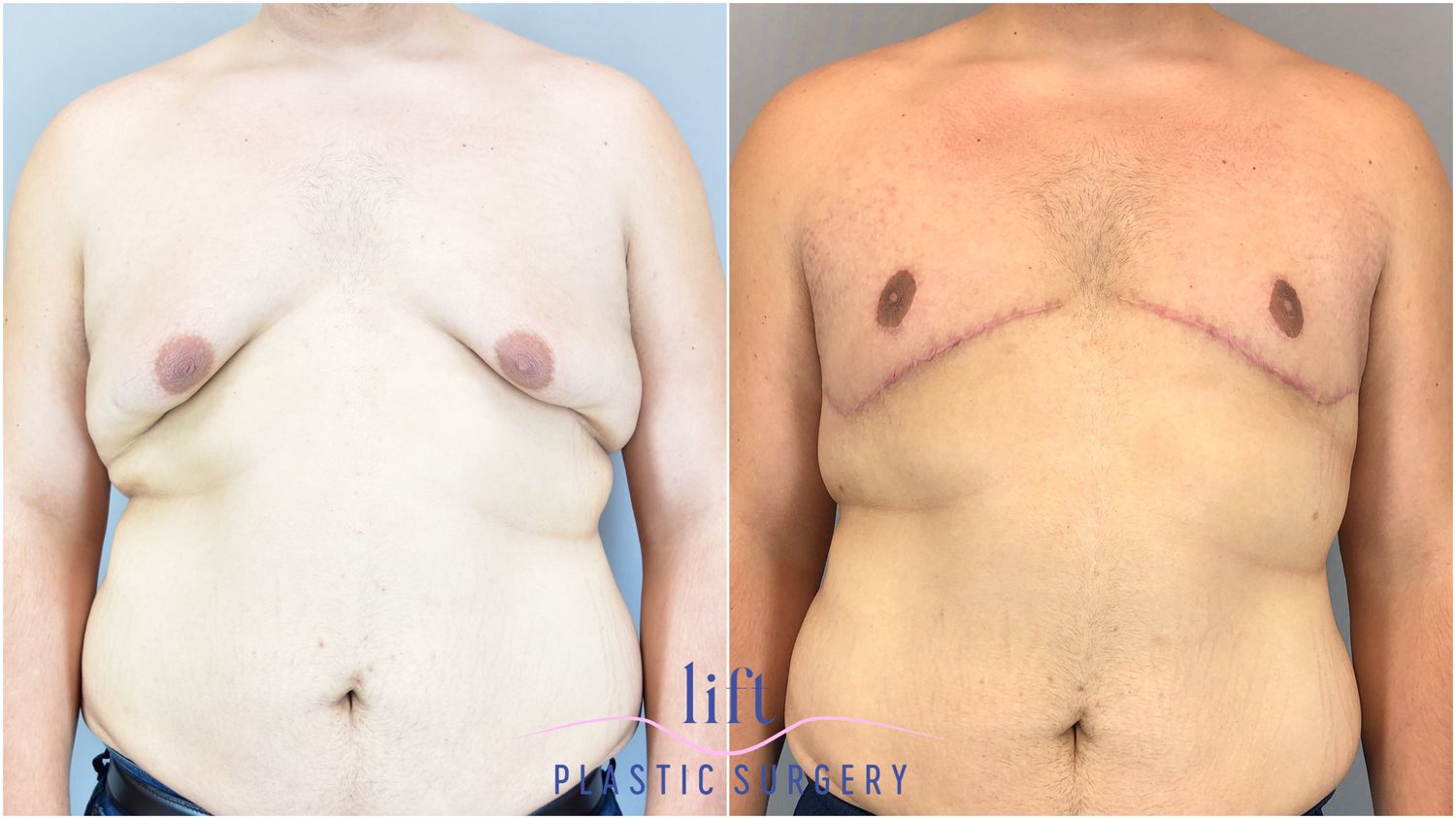 Male Breast Reduction (Gynecomastia) Before &#038; After Photos