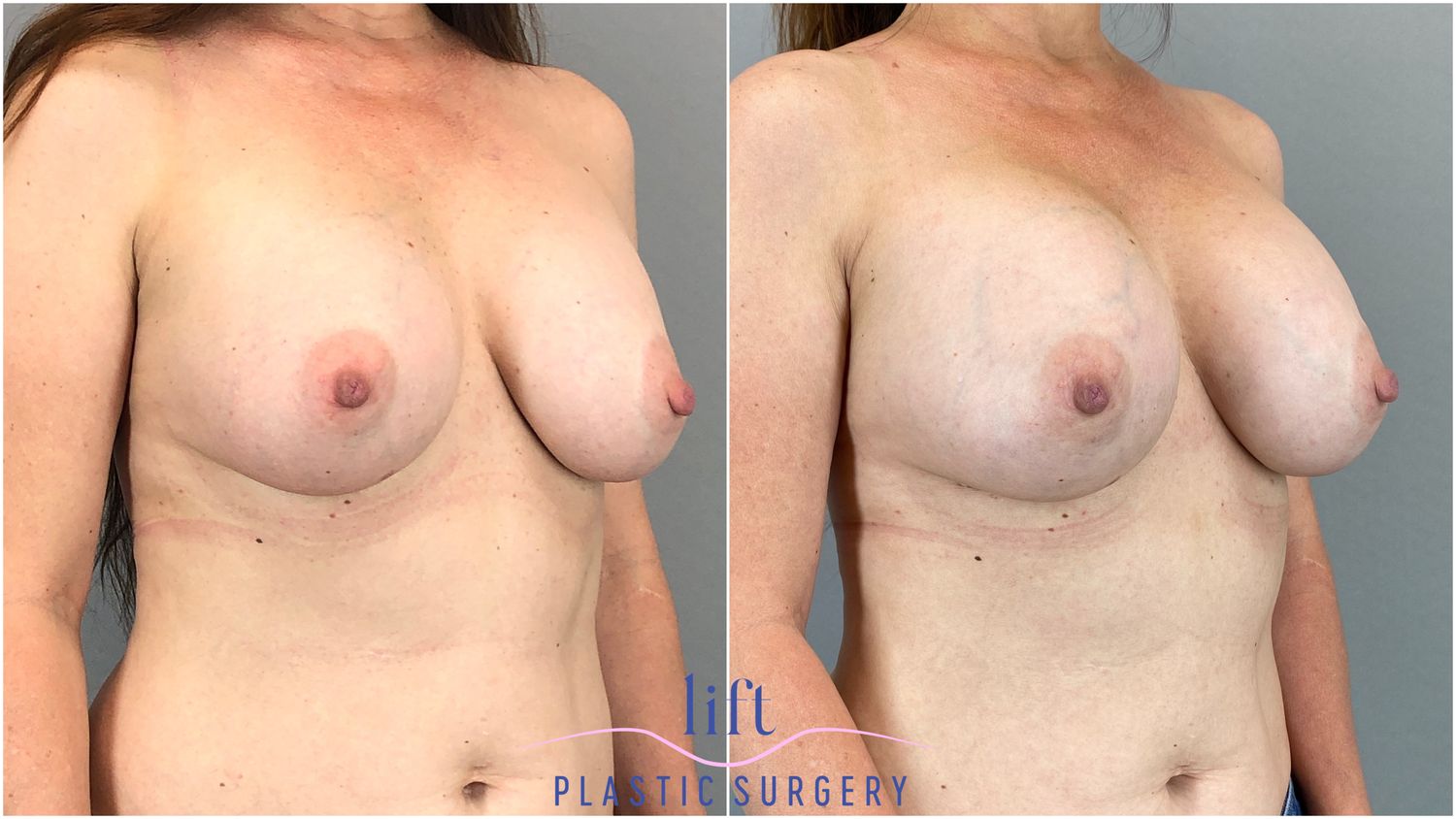 Breast Implant Exchange Before &#038; After Photos