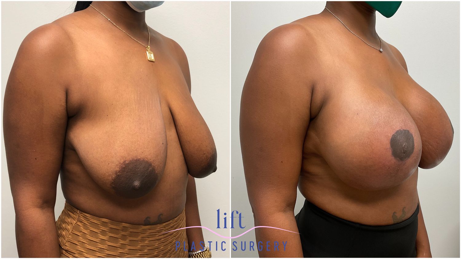 Breast Lift Before &#038; After Photos