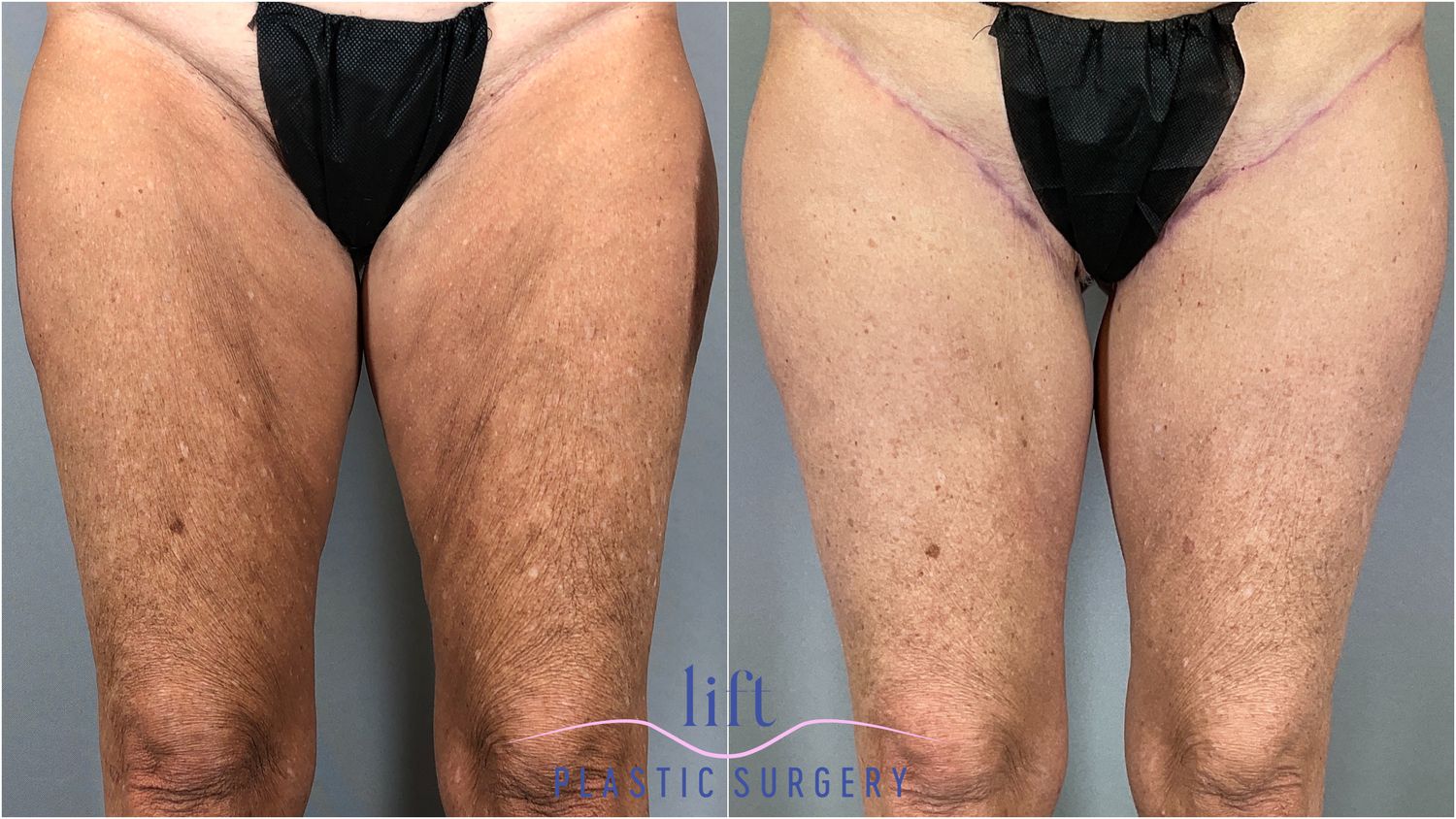 Thigh Lift Before &#038; After Photos