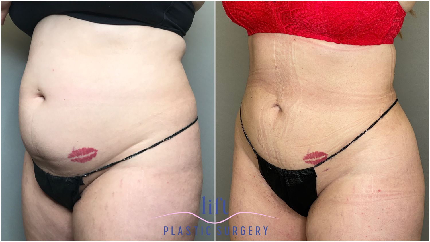 Liposuction Before &#038; After Photos