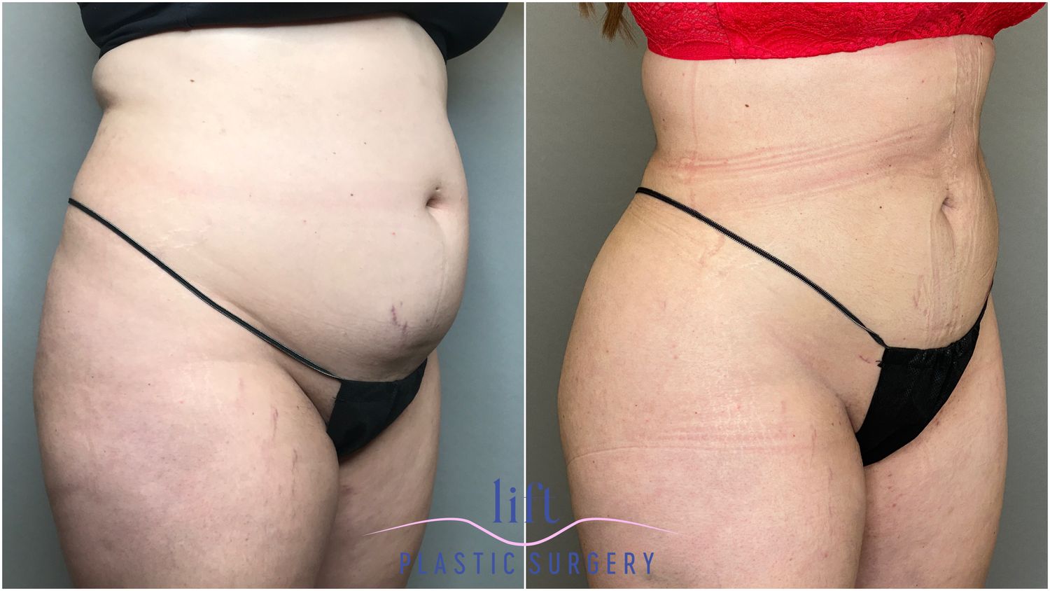 Body Lift Before &#038; After Photos