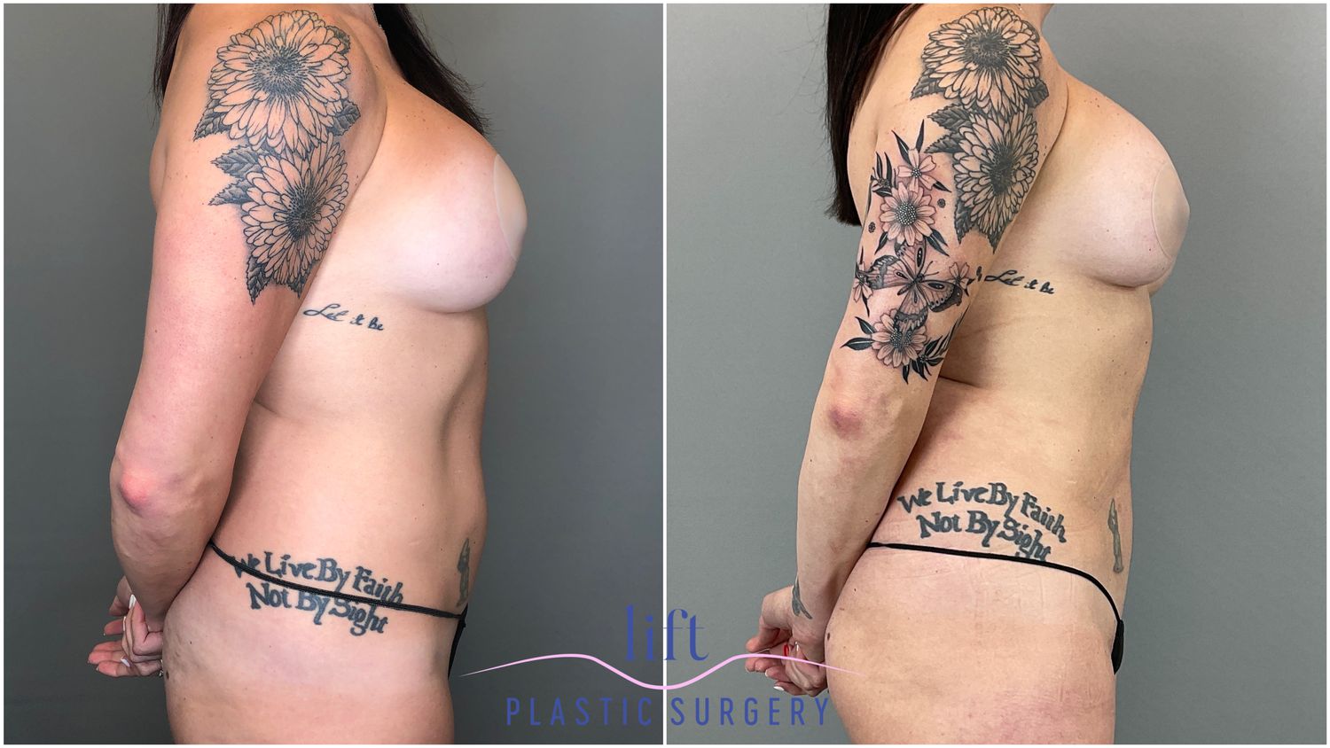 Liposuction Before &#038; After Photos