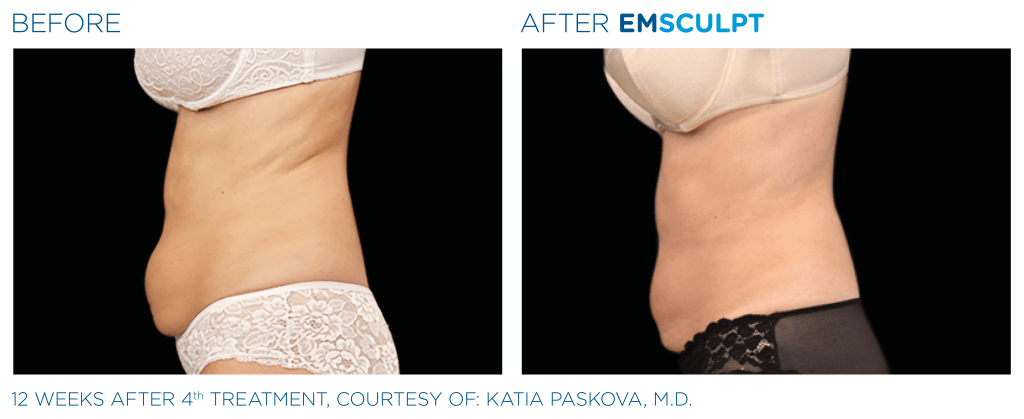 Body and Muscle Contouring with EMSCULPT | Houston, TX