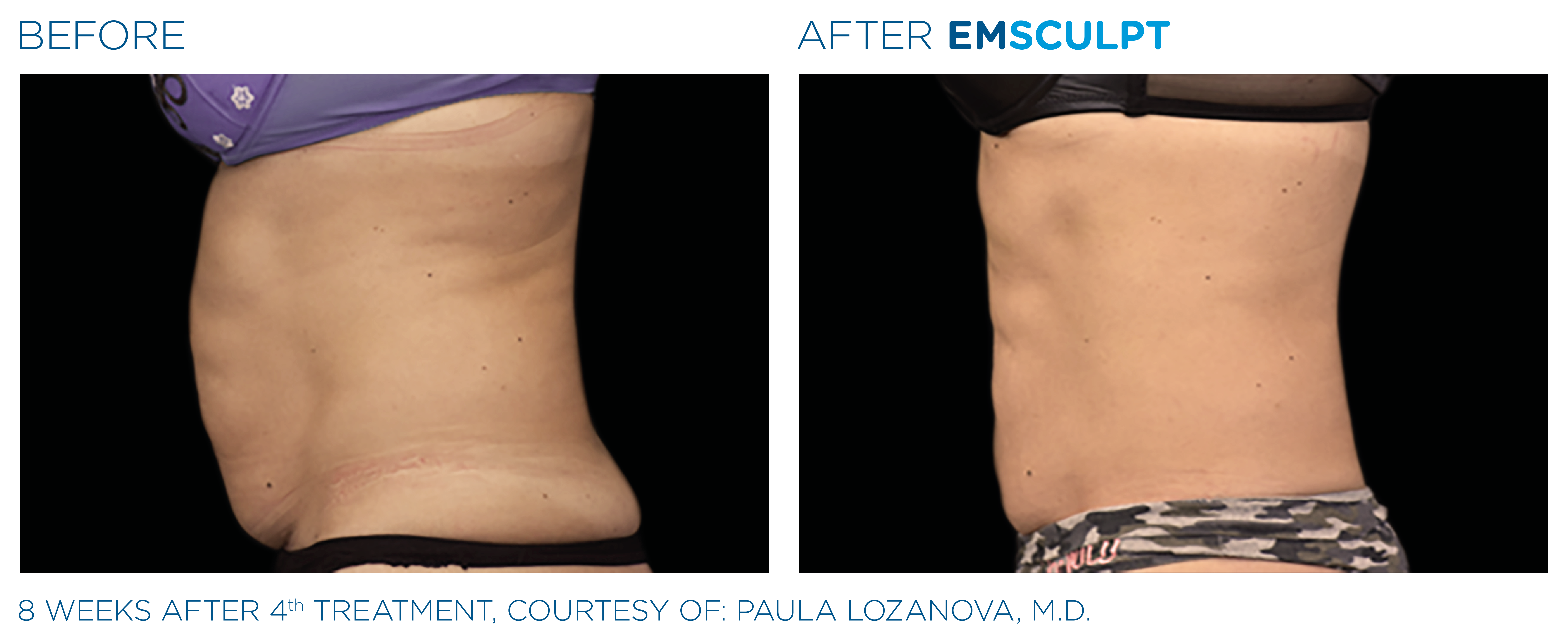 Body and Muscle Contouring with EMSCULPT | Houston, TX