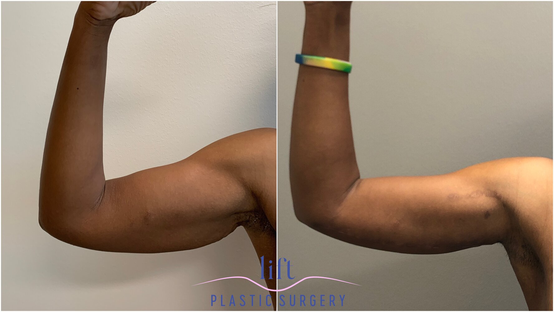 Arm Lift Before &#038; After Photos