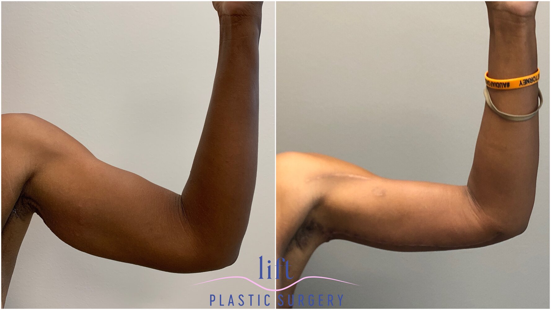 Arm Lift Before &#038; After Photos