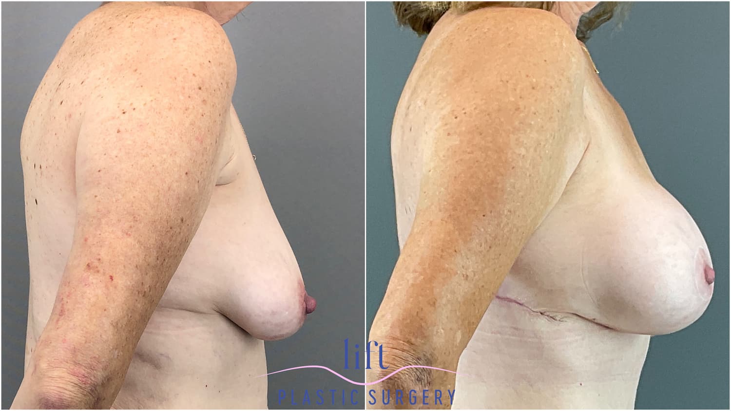 Breast Augmentation Before &#038; After Photos