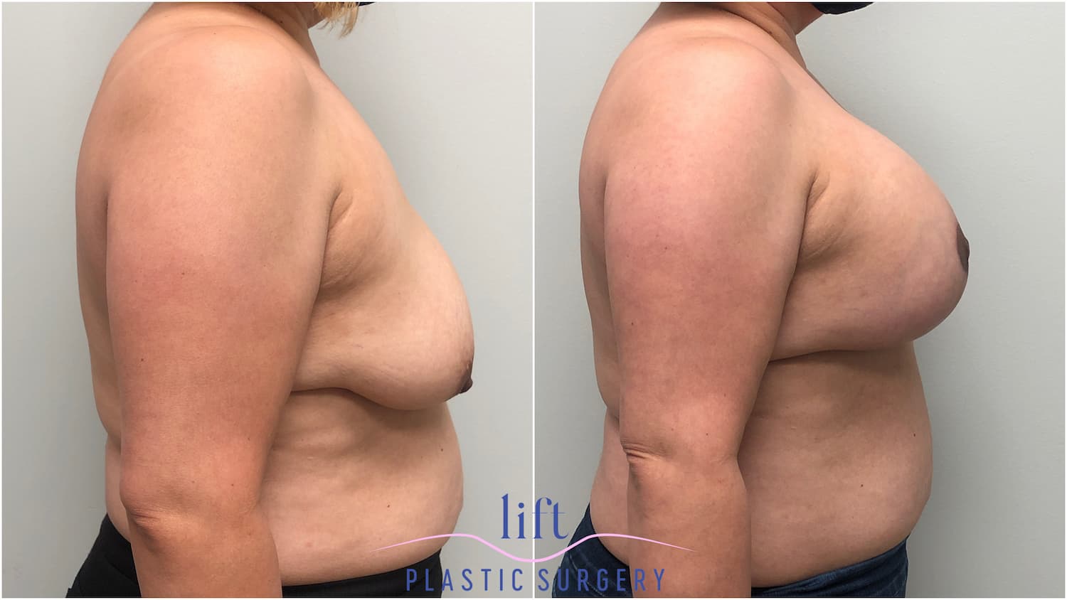 Breast Lift Before &#038; After Photos