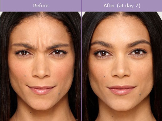 Botox Cosmetic to Reduce Wrinkles