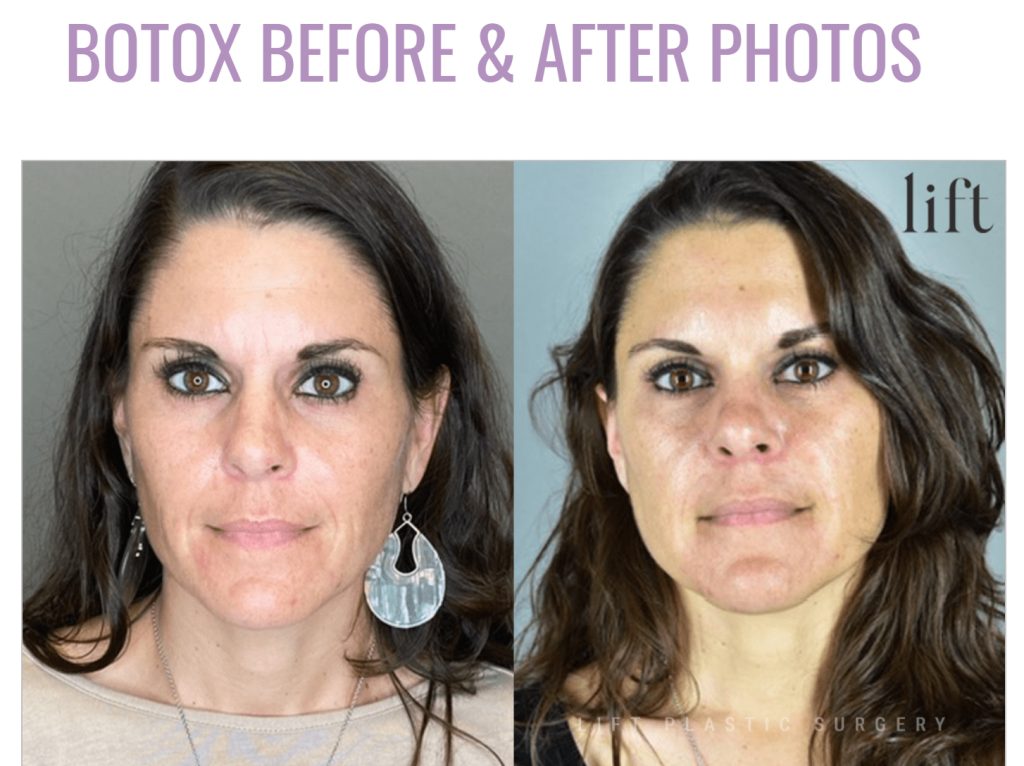 Botox Cosmetic Before And After Photos