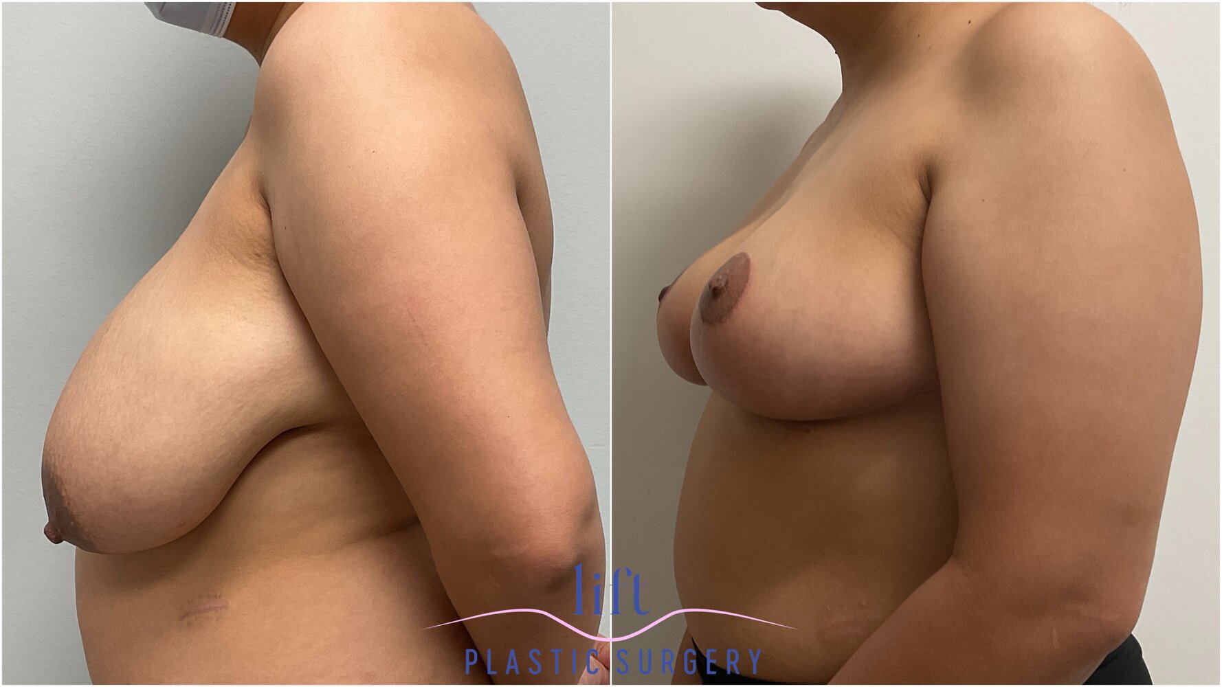 Breast Reduction Before &#038; After Photos