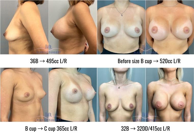 Breast Augmentation With Fat Grafting Before And After Pictures