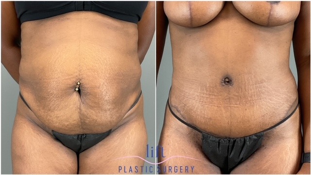 Tummy Tuck Before &#038; After Photos