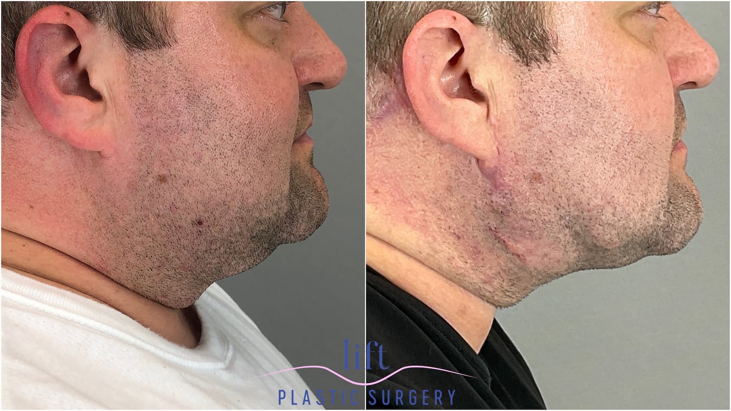 Neck Lift Before &#038; After Photos