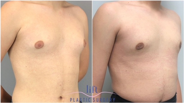 Male Breast Reduction (Gynecomastia) Before &#038; After Photos