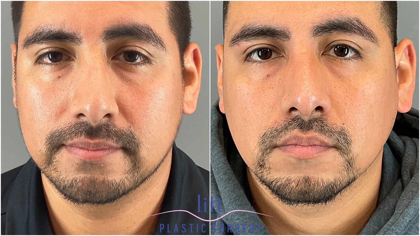 Rhinoplasty Before &#038; After Photos