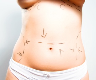 Best Questions To Ask Before Tummy Tuck Plastic Surgery