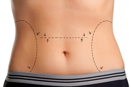 What Should You Expect During A Tummy Tuck Surgery Consultation?