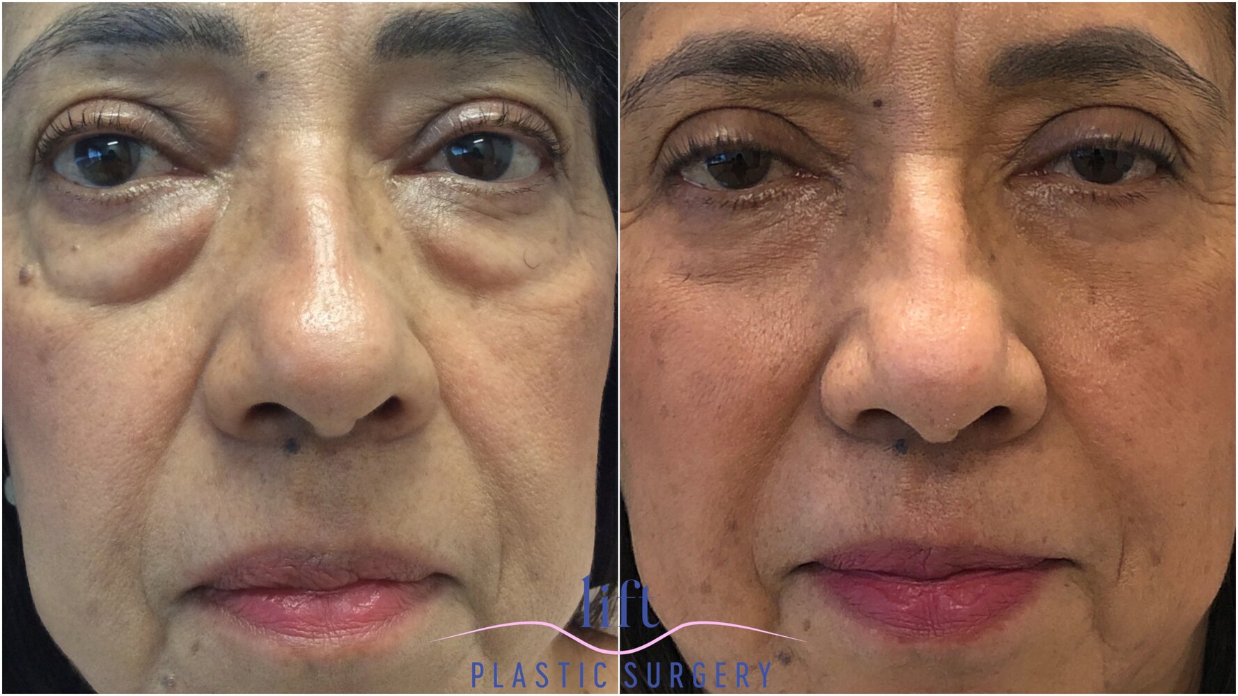 Eyelid Surgery (Blepharoplasty) Before &#038; After Photos