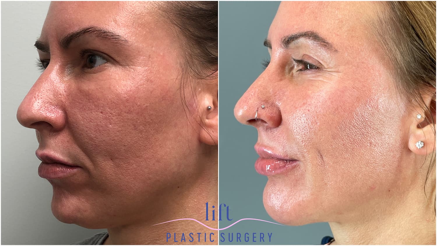 Chin Augmentation Before &#038; After Photos