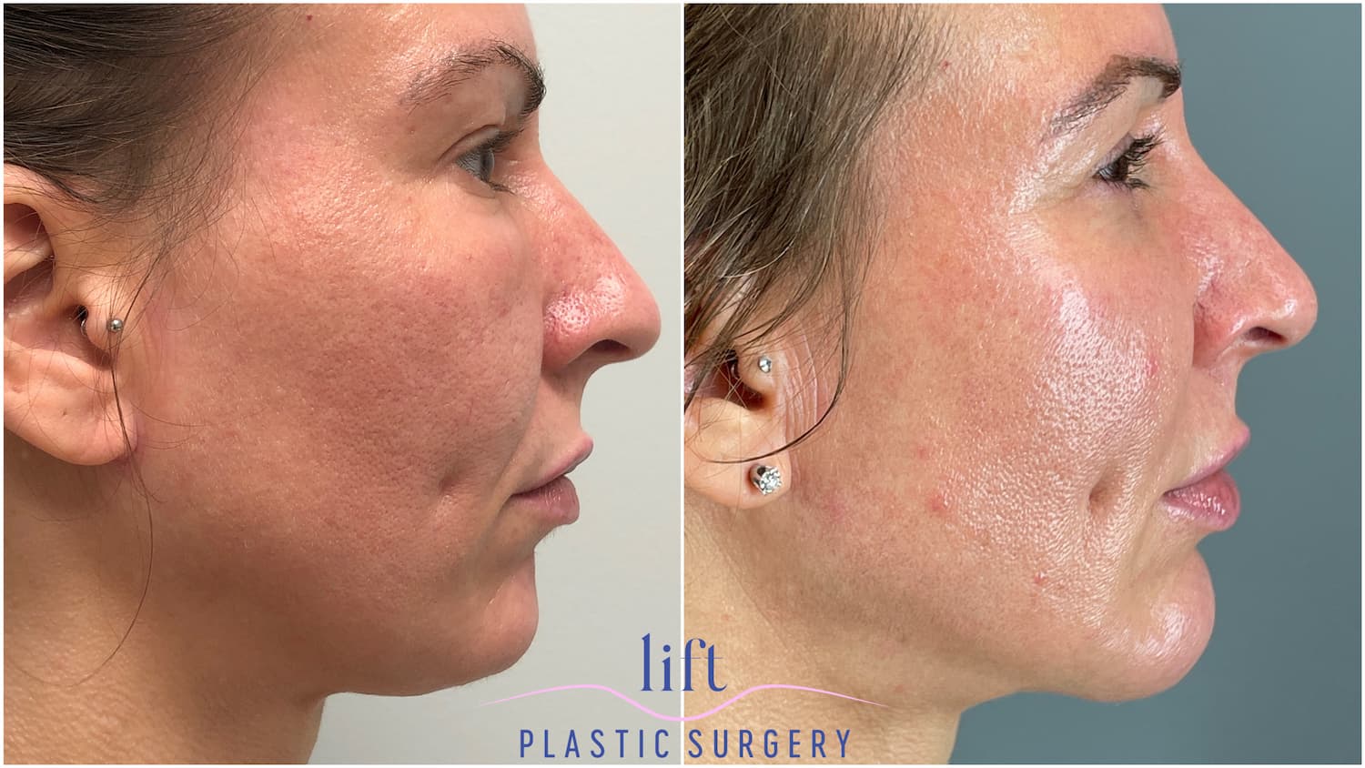 Chin Augmentation Before &#038; After Photos
