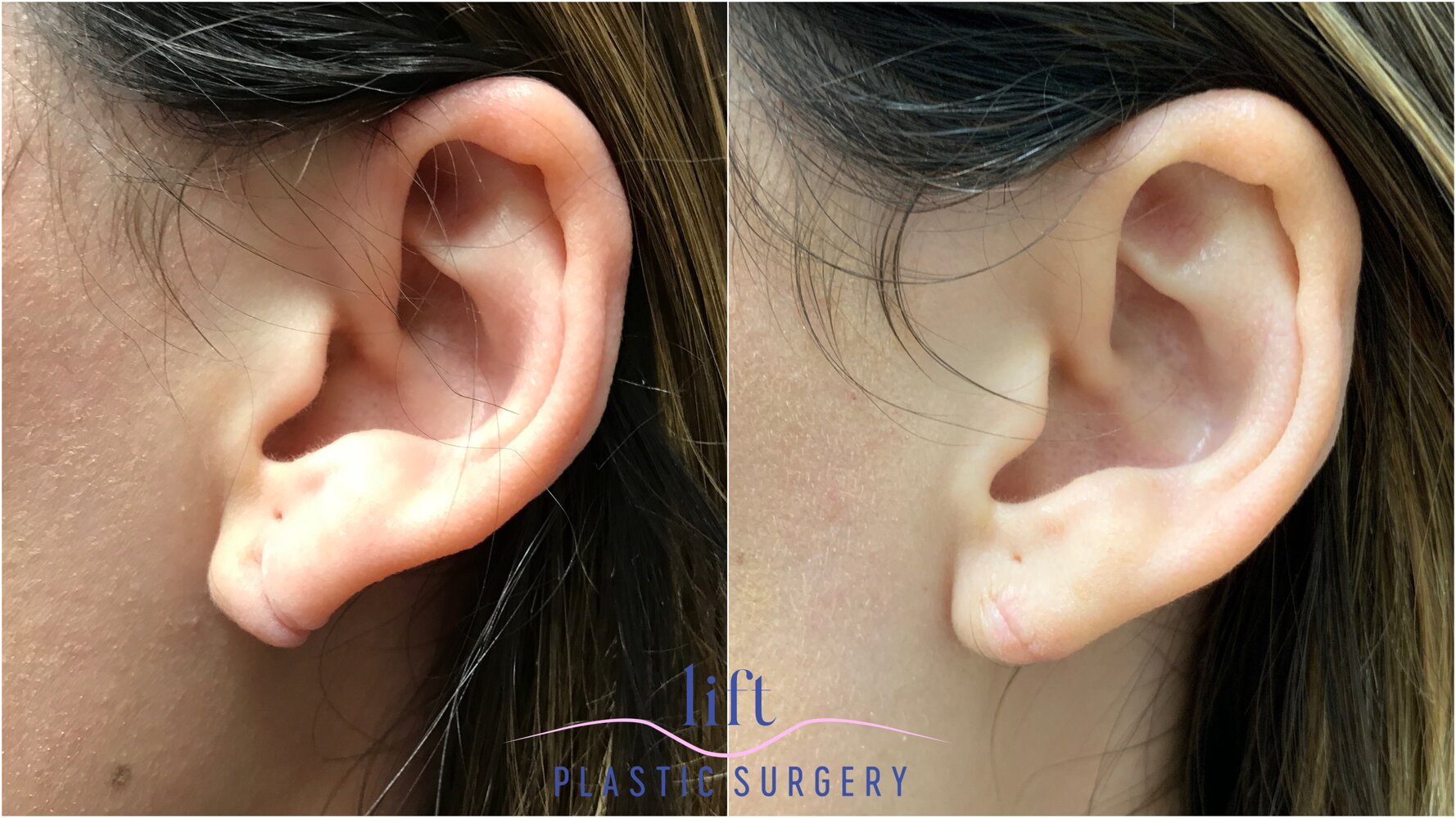 Ear Surgery Before &#038; After Photos