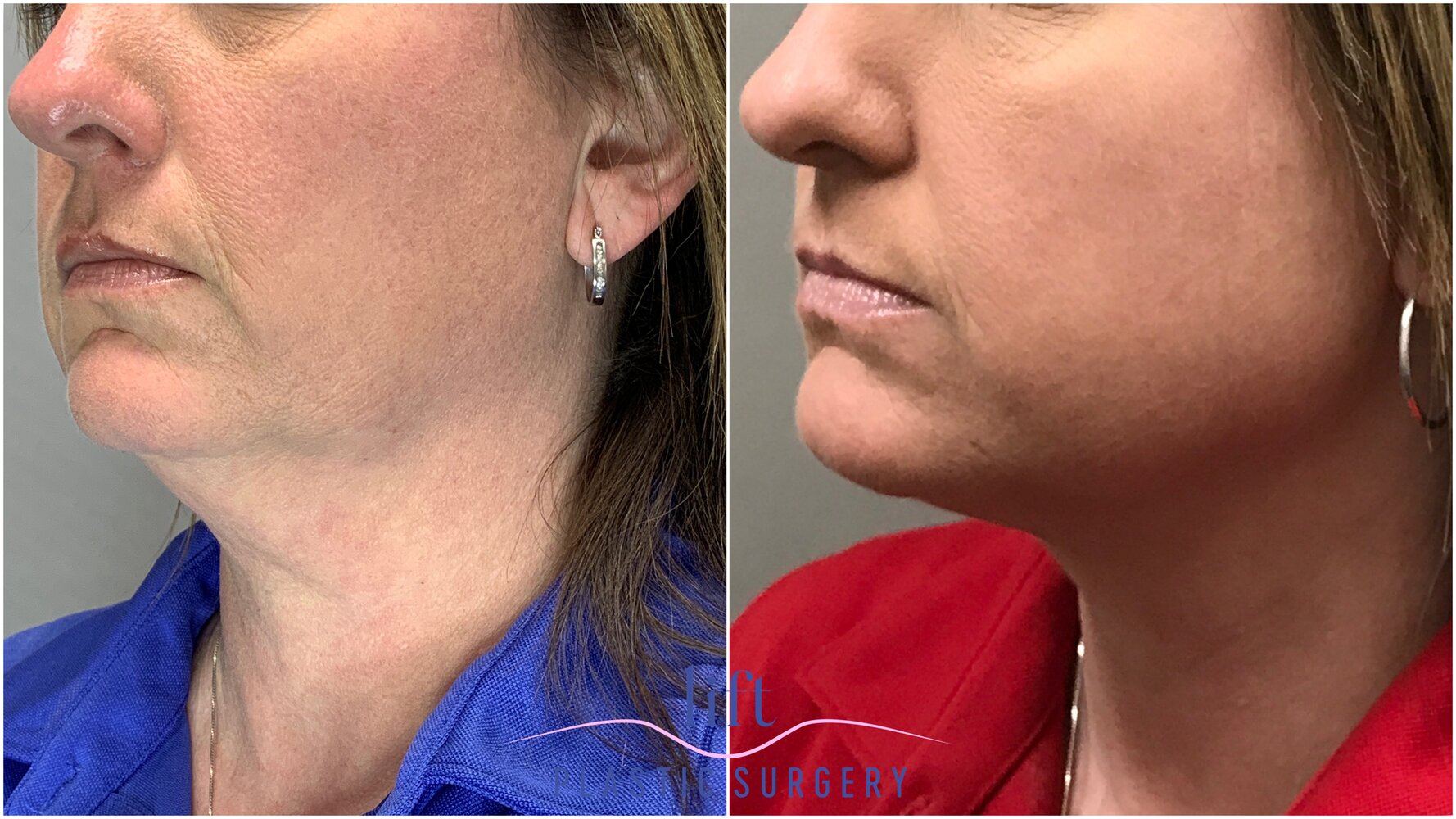 NeckTite Before &#038; After Photos