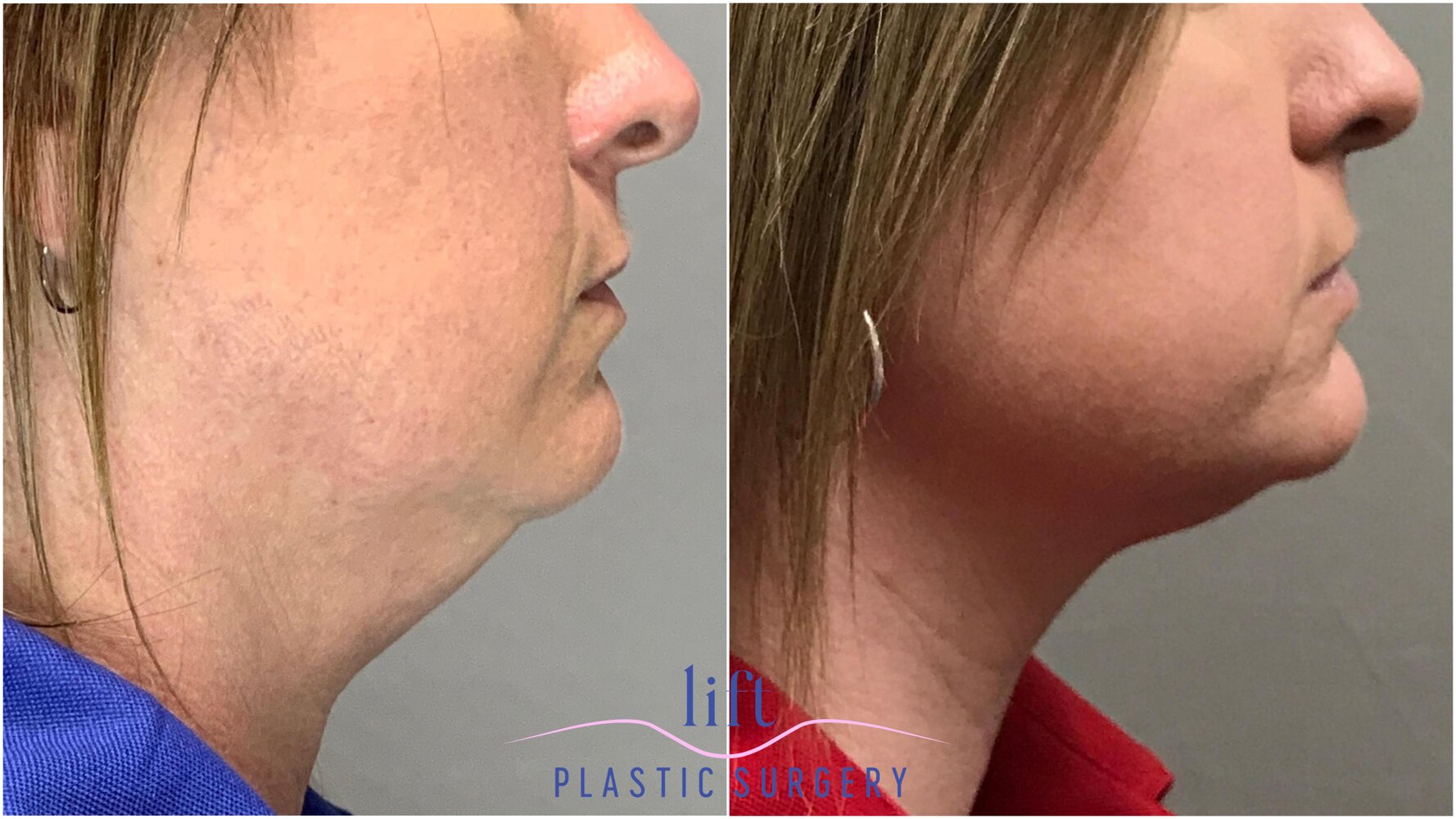 NeckTite Before &#038; After Photos