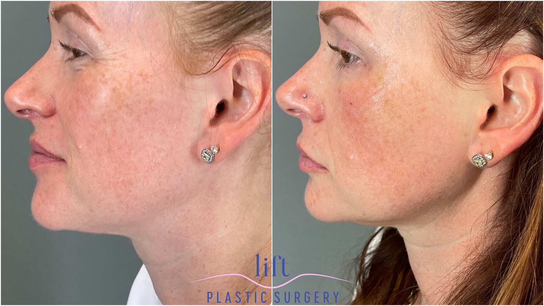Injectables Before &#038; After Photos